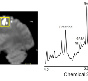 Left: Magnetic resonance imaging (MRI) was used to locate the part of the brain that controls movement. Right: The amounts of excitatory and inhibitory chemicals in this brain region were measured using spectroscopy.