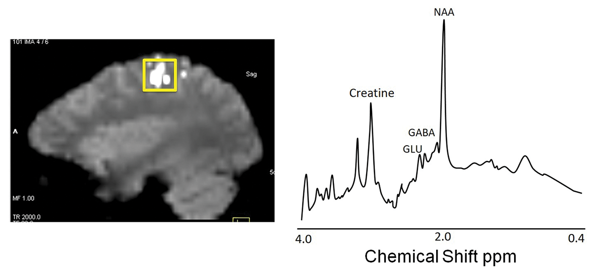 Left: Magnetic resonance imaging (MRI) was used to locate the part of the brain that controls movement. Right: The amounts of excitatory and inhibitory chemicals in this brain region were measured using spectroscopy.